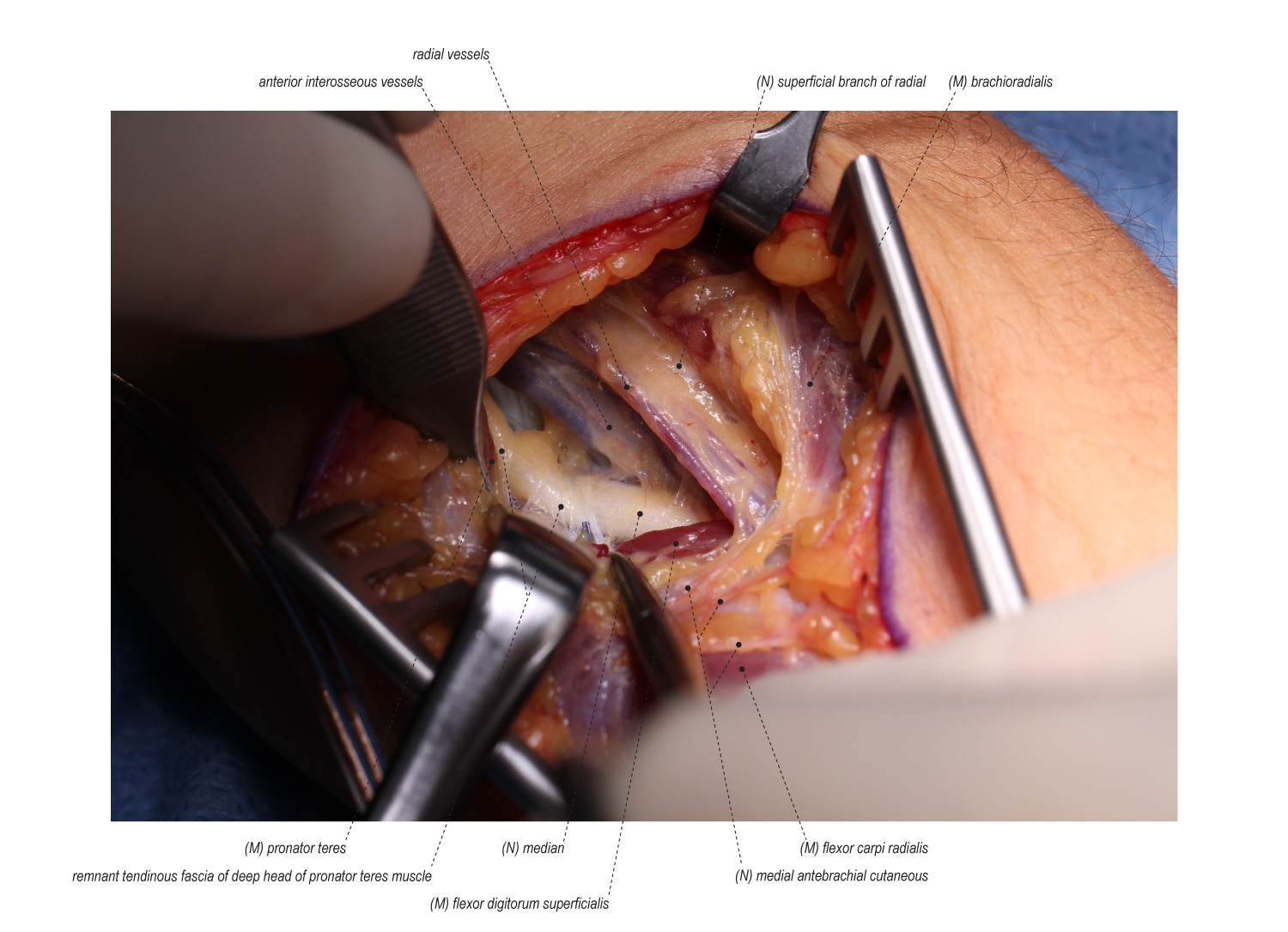 Median Nerve Release in the Forearm | Surgical Education / Learn