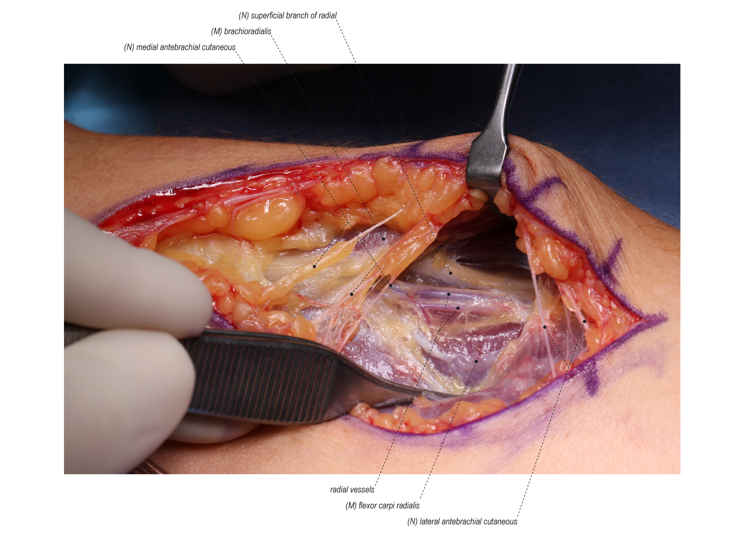 Median Nerve Release in the Forearm | Surgical Education / Learn